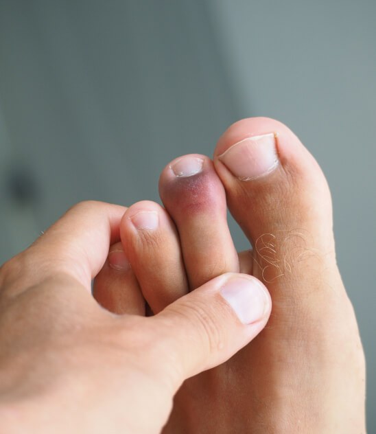 Checking feet for fungus